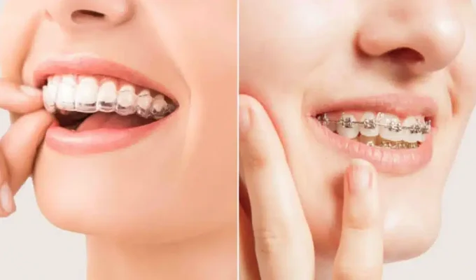 Clear-Aligner-