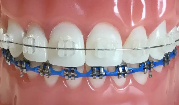 ceramic+and+metal+braces