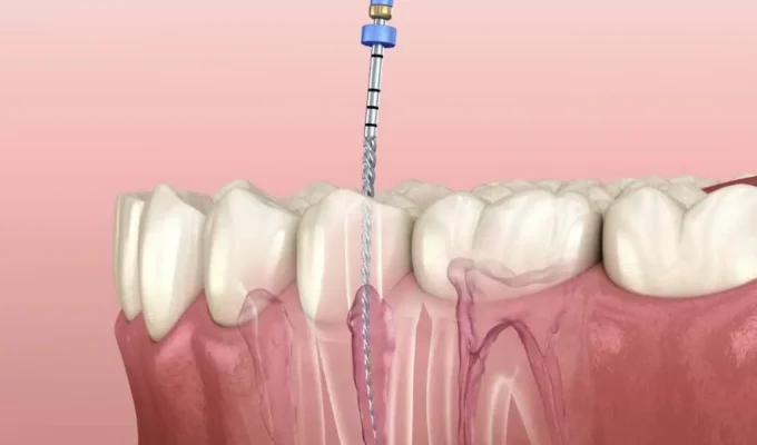 root canal