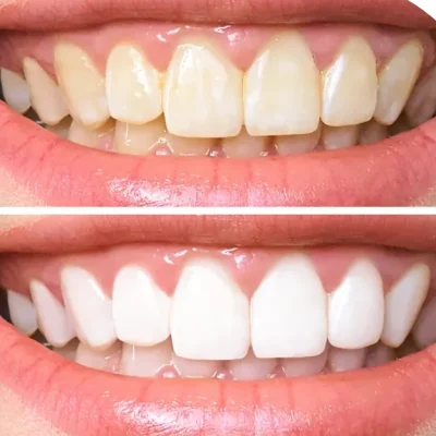Before and after smile makeover by a cosmetic dentist in Mumbai and Thane