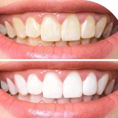 Before and after smile makeover by a cosmetic dentist in Mumbai and Thane