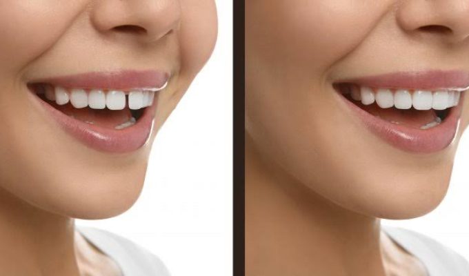 teethh gap