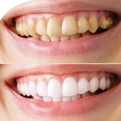 Before and after smile makeover by a cosmetic dentist in Mumbai and Thane